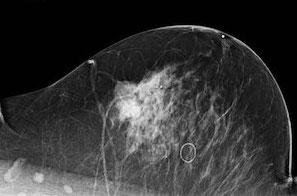 Microcalcification-Analysis-SVM